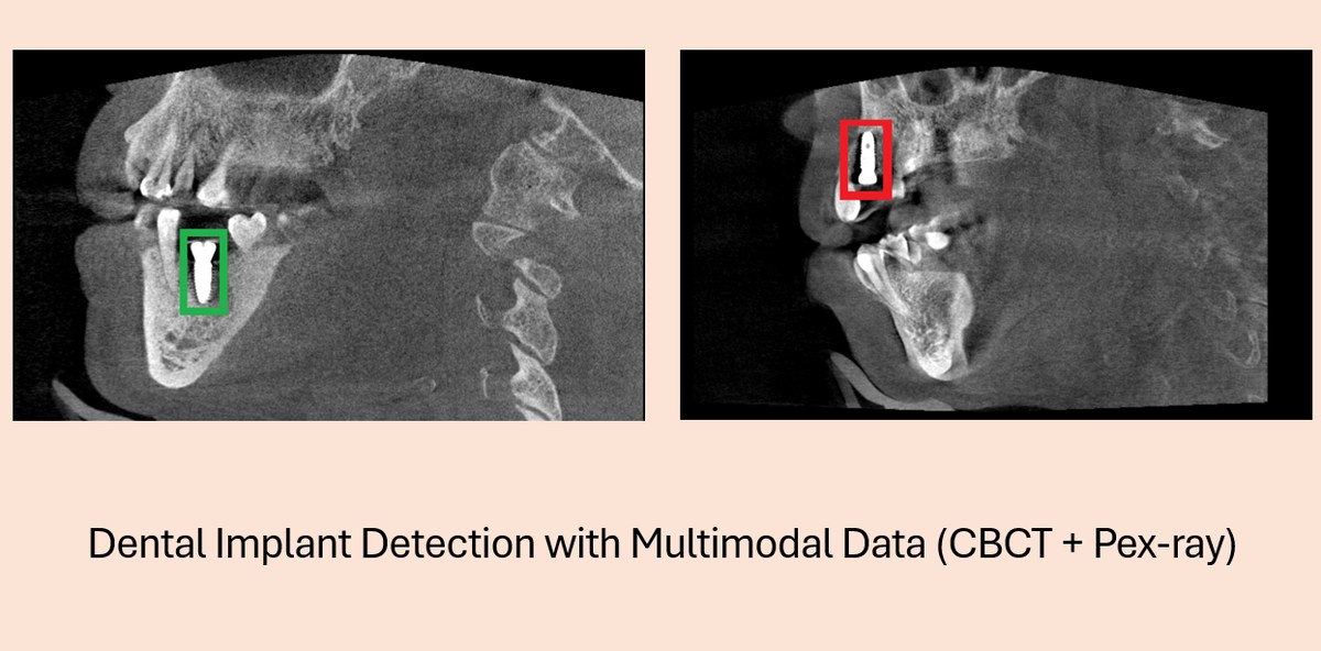 牙种植体 multimodal detection 示例，展示 CBCT 与 Pex-ray 中的 implant bounding box